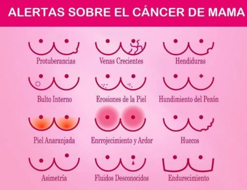 Señales de advertencia del cáncer de mama * MG LAB