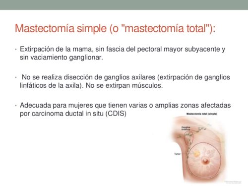 Mastectomía simple * MG LAB